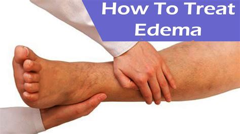 Edema: Causes, Symptoms & Treatment